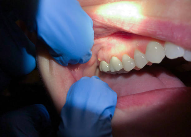 Best Emergency Gum Treatment in , ND